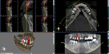 Dental implants 3D scan - multiple views